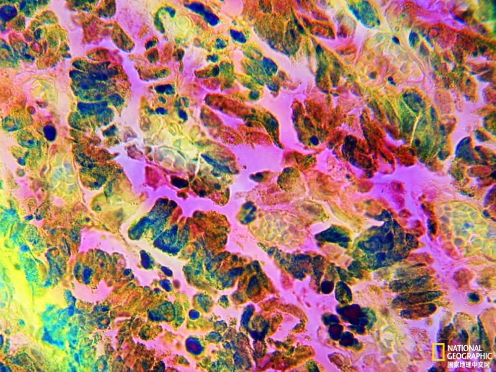 恶性黑色素瘤（粉红色）是最可怕的人类肿瘤之一
